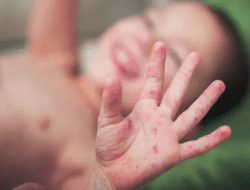 Wabah Campak di Pamekasan Telan 11 Korban Jiwa, Dinkes Tetapkan Status KLB